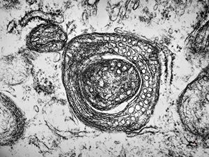 M,1y. | unusually cup-shaped mitochondria - plexus papilloma